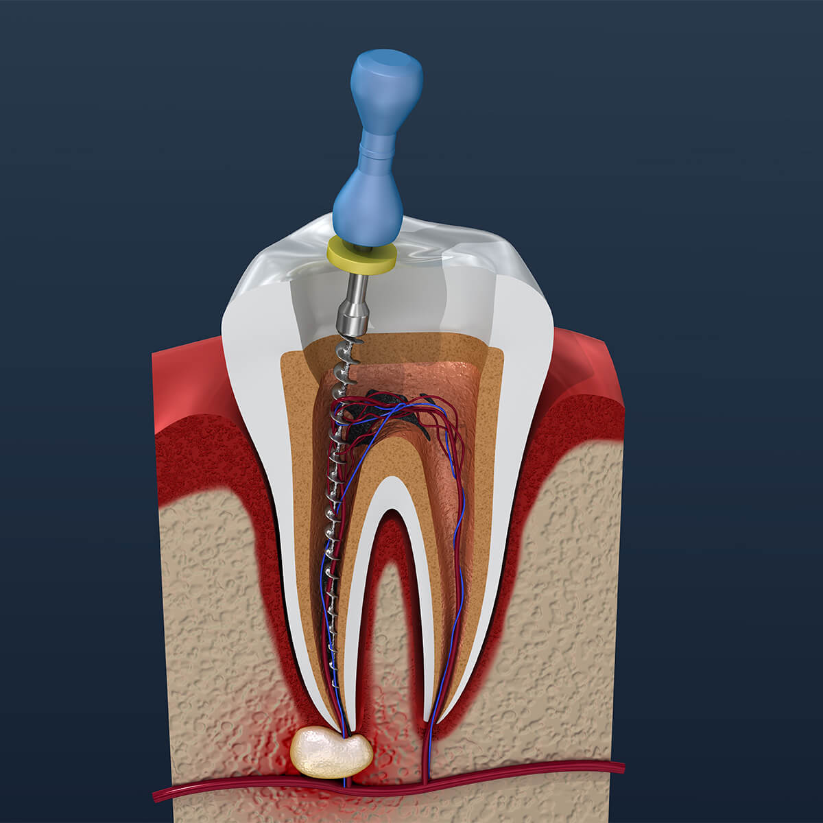 How Long Will A Root Canal Take in Vista CA Area